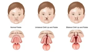 Abnormalities of the face