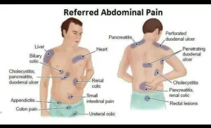 Referred pain