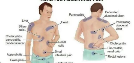 Referred pain