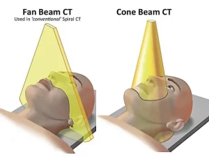 Cone beam vs. Fan beam CT