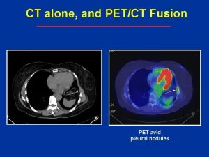 Positron emission tomography (PET)/CT scans