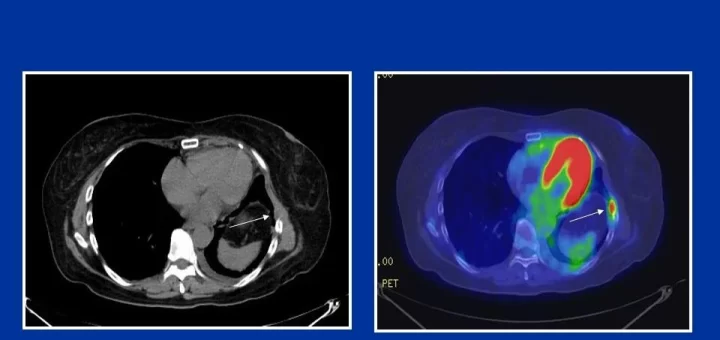 Positron emission tomography (PET)/CT scans
