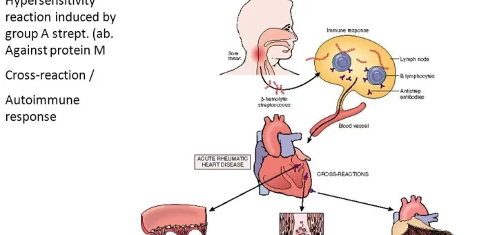 Pathogenesis of rheumatic fever