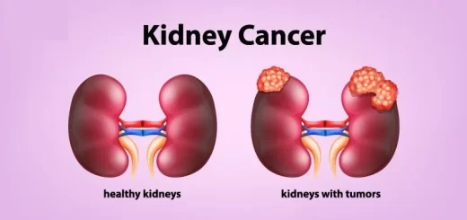 Tumors of the kidney