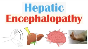 Hepatic Encephalopathy