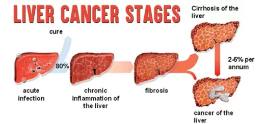 Hepatic Tumors stages