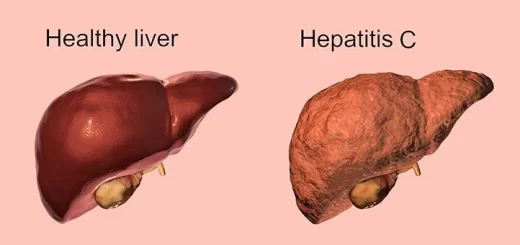 Viral hepatitis