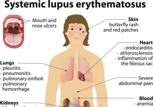 Systemic Lupus Erythematosus 