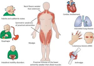 Idiopathic Inflammatory Myopathies