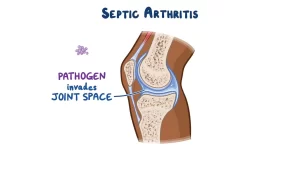 Septic Arthritis