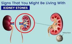 Stones in the kidney or ureter