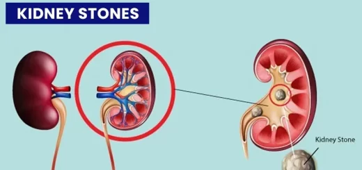 Stones in the kidney or ureter