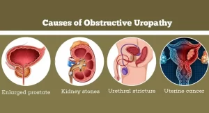 Obstructive Uropathy.