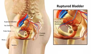 Injuries to the Bladder