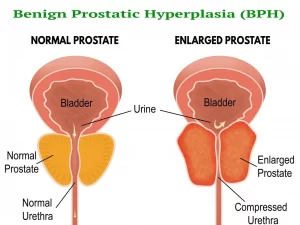 Benign Prostatic Hyperplasia