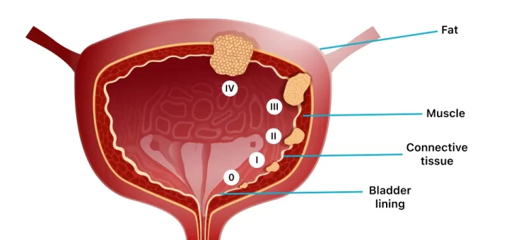 Carcinoma of the bladder