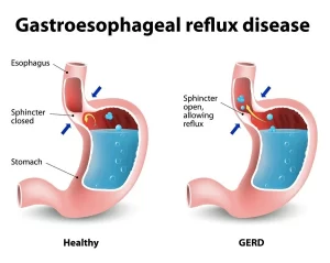 Gastroesophageal reflux disease