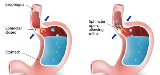 Gastroesophageal reflux disease