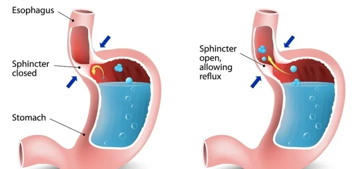 Gastroesophageal reflux disease