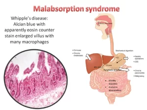 Malabsorption syndrome