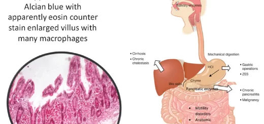 Malabsorption syndrome