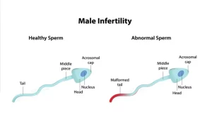 Male infertility causes