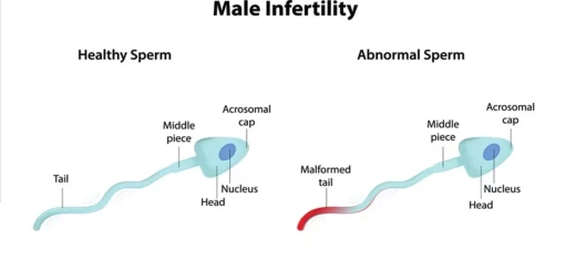 Male infertility causes