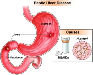 Peptic Ulcer Diseases 