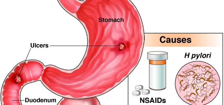 Peptic Ulcer Diseases