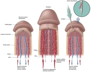 Priapism Symptoms