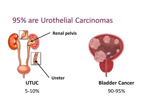 Upper urinary tract neoplasms 