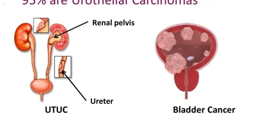 Upper urinary tract neoplasms