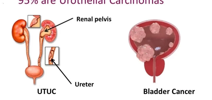 Upper urinary tract neoplasms