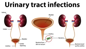 Urinary tract infection