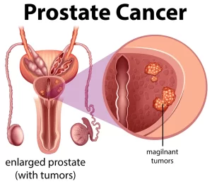 Prostate cancer