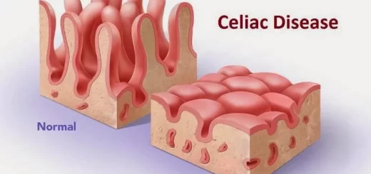 Celiac disease (CD)