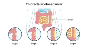 Colorectal cancer stages