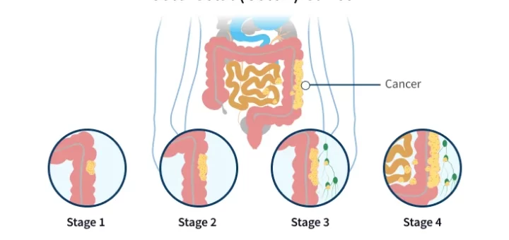 Colorectal cancer stages