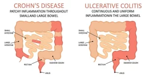 Inflammatory bowel disease