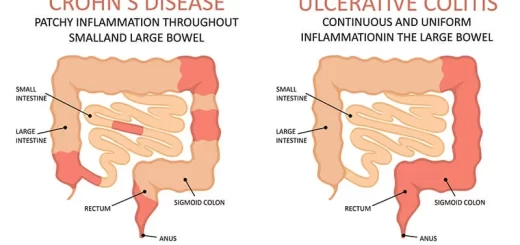 Inflammatory bowel disease