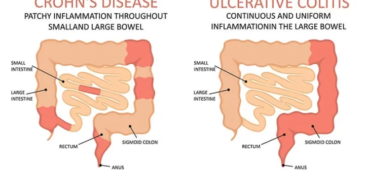 Inflammatory bowel disease