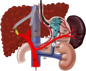 Treatment of Gastric Varices