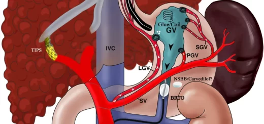 Treatment of Gastric Varices