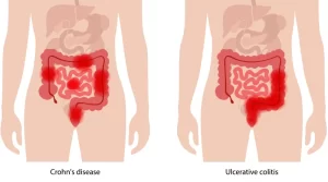 Ulcerative colitis