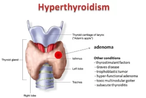 Hyperthyroidism