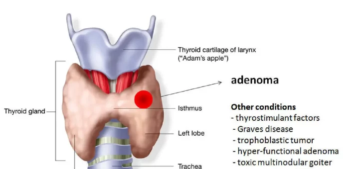 Hyperthyroidism