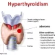 Hyperthyroidism