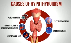 Hypothyroidism causes