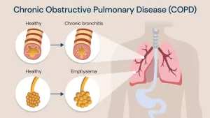 Chronic obstructive pulmonary diseases