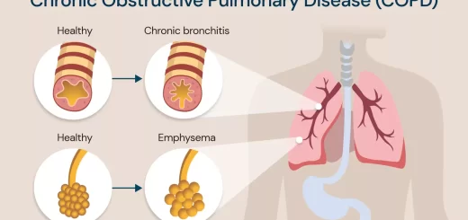 Chronic obstructive pulmonary diseases